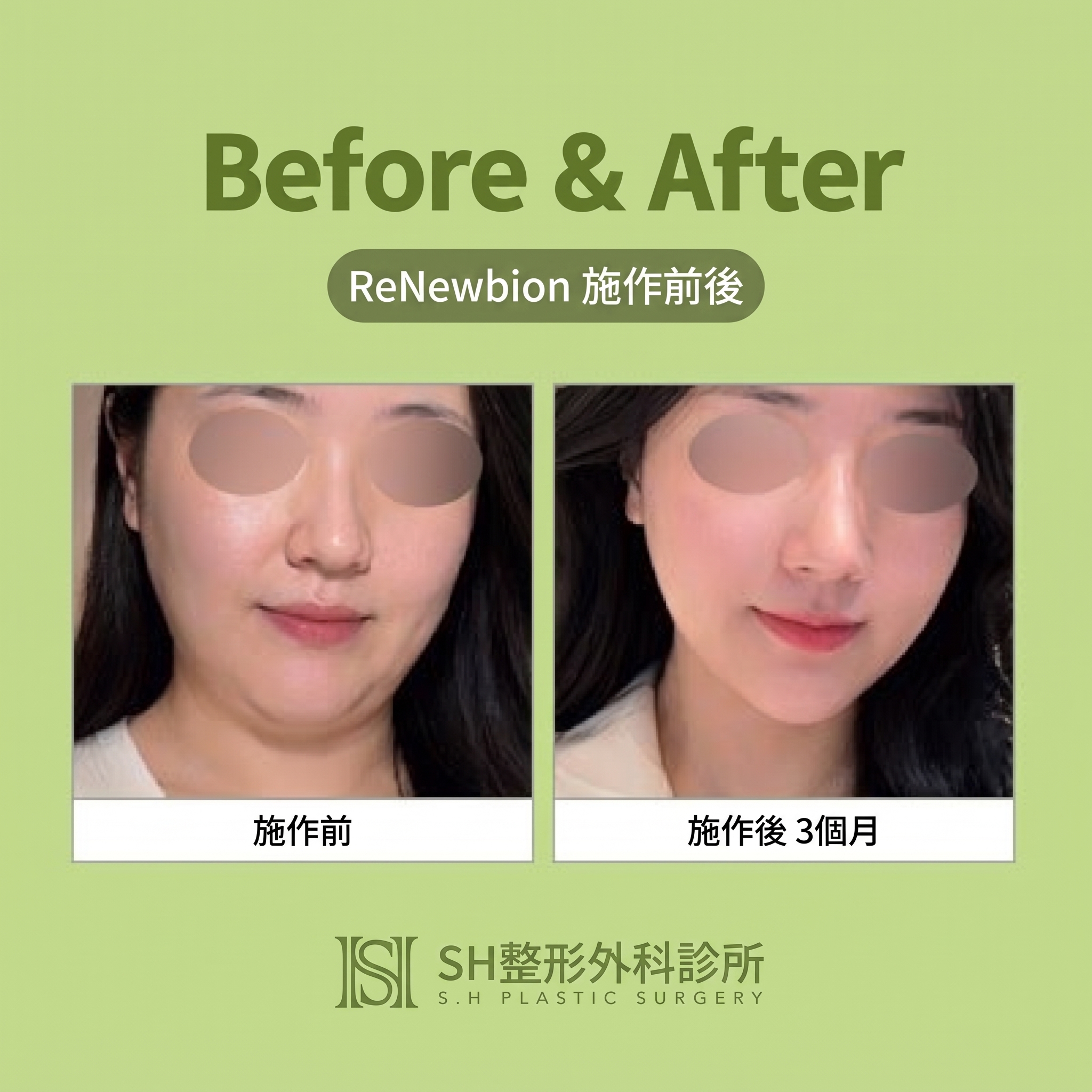 Renuvion臉部拉提 (sh)SH整形外科為您介紹非侵入式臉部拉提術~ 사진 2