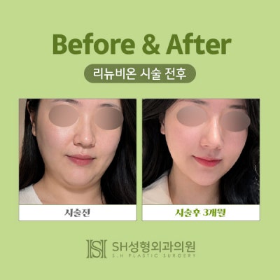 리뉴비온얼굴리프팅 (sh)에스에이치성형외과에서 비절개안면거상 알려드립니다~ 사진 2