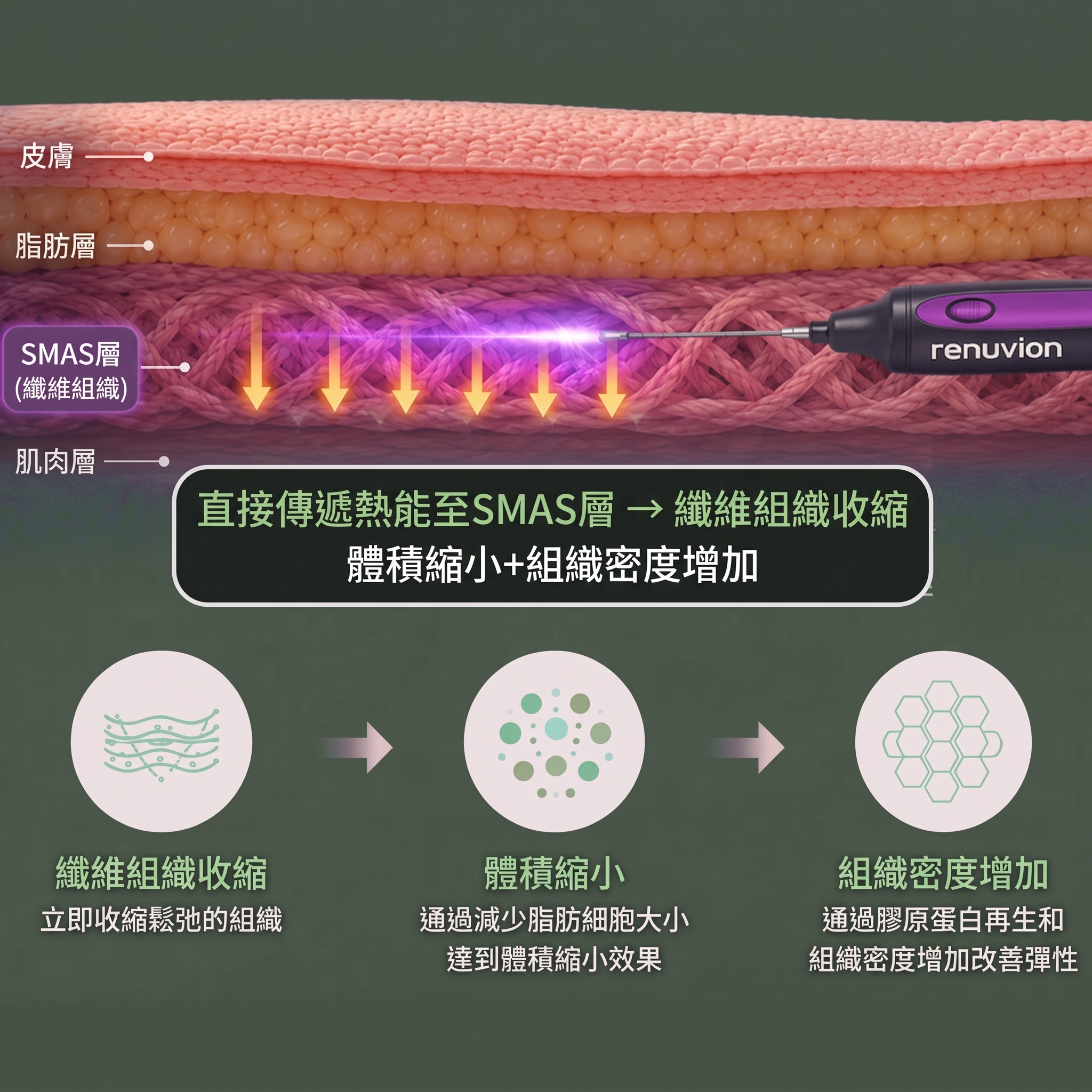 Renuvion臉部拉提 (sh)SH整形外科為您介紹非侵入式臉部拉提術~ 사진 11