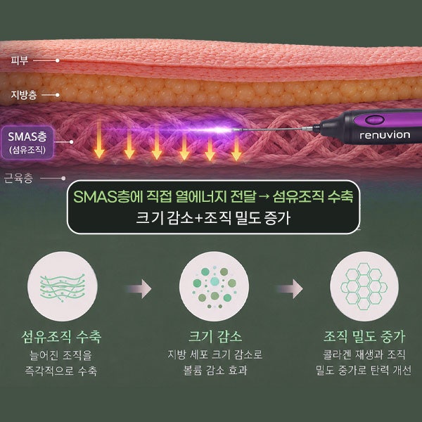 리뉴비온얼굴리프팅 (sh)에스에이치성형외과에서 비절개안면거상 알려드립니다~ 사진 11