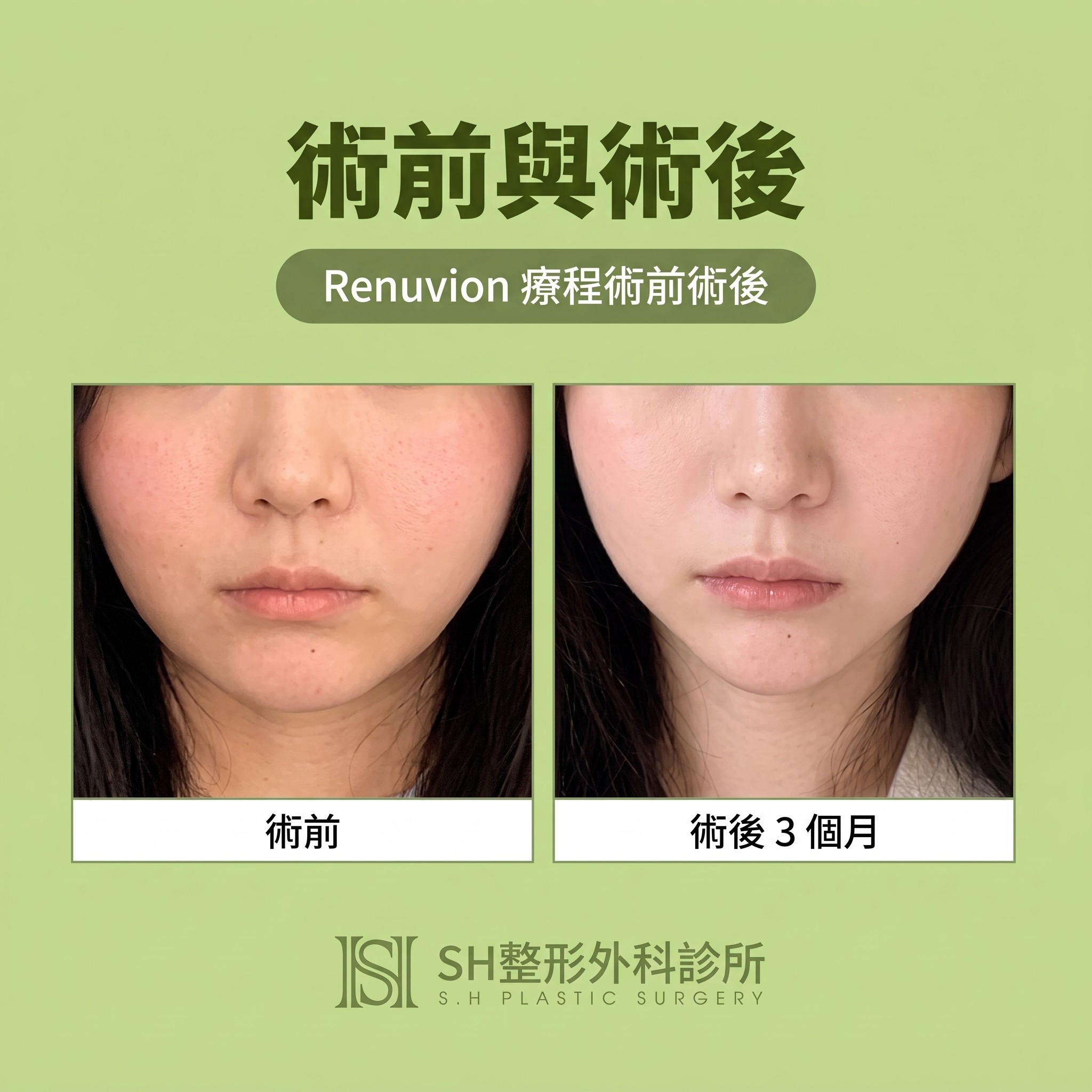Renuvion臉部拉提 (sh)SH整形外科為您介紹非侵入式臉部拉提術~ 사진 5