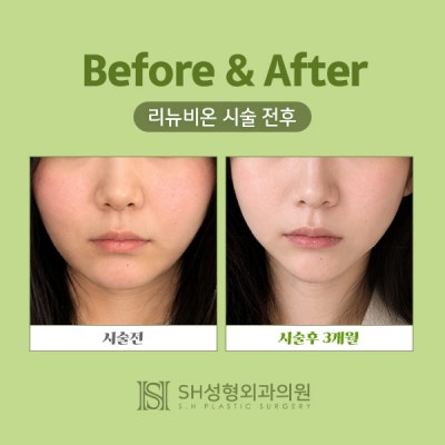 리뉴비온얼굴리프팅 (sh)에스에이치성형외과에서 비절개안면거상 알려드립니다~ 사진 5